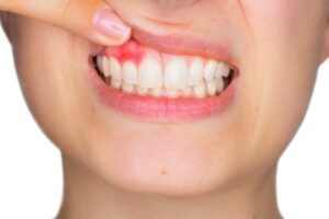 Do You Know What a Periodontal Disease Is?